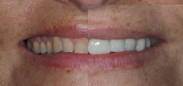 Cas du mois - Dents réduites par usure avec des facettes en céramique collées