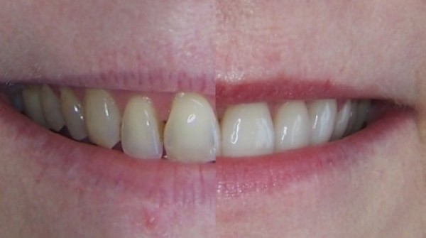Cas du mois - Eclaircissement définitif des dents par des facettes en céramique