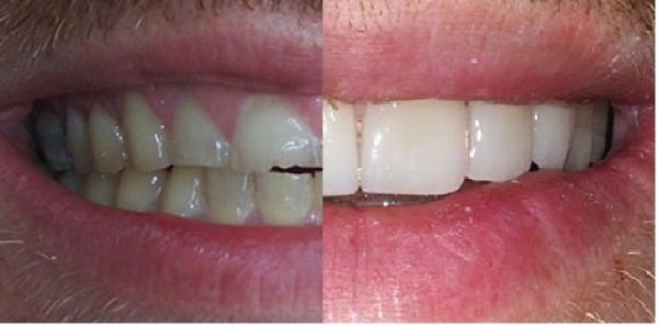 Cas du mois - Usures très importantes des dents due au bruxisme
