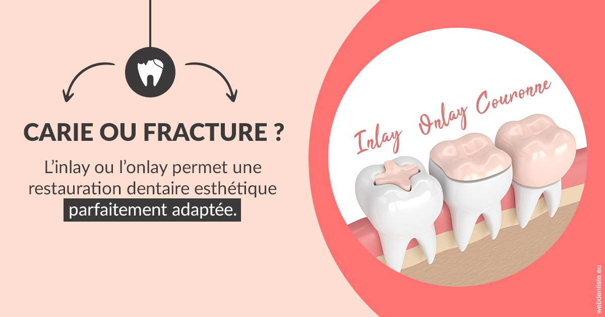 https://dr-assayag-nadine.chirurgiens-dentistes.fr/T2 2023 - Carie ou fracture 2