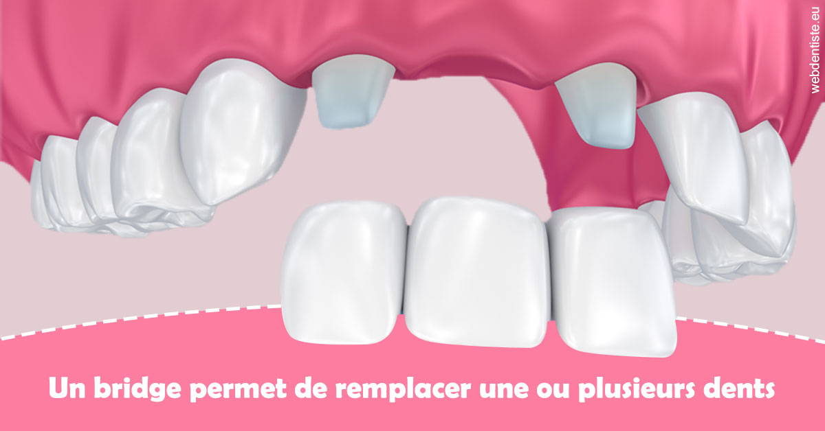 https://dr-assayag-nadine.chirurgiens-dentistes.fr/Bridge remplacer dents 2