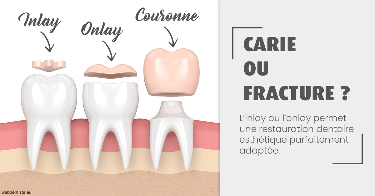 https://dr-assayag-nadine.chirurgiens-dentistes.fr/T2 2023 - Carie ou fracture 1