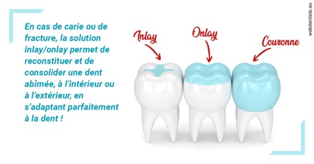 https://dr-assayag-nadine.chirurgiens-dentistes.fr/L'INLAY ou l'ONLAY