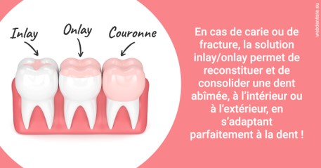 https://dr-assayag-nadine.chirurgiens-dentistes.fr/L'INLAY ou l'ONLAY 2