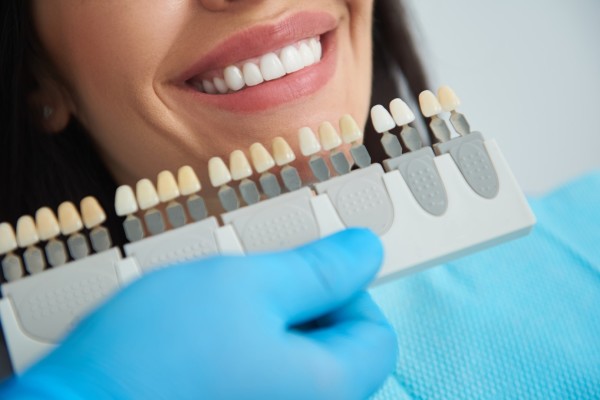 6 - Facettes Dentaires: traitement de choix des anomalies de position