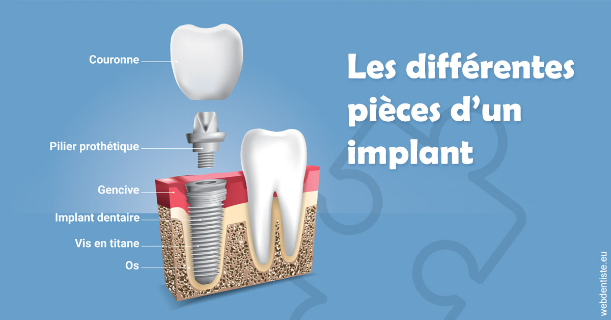 https://dr-assayag-nadine.chirurgiens-dentistes.fr/Les différentes pièces d’un implant 1