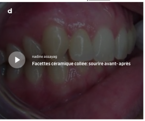 Incisives laterales et facettes dentaire à Paris par joke1307